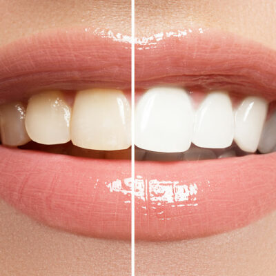 7 Effective At-home Teeth Whitening Procedures