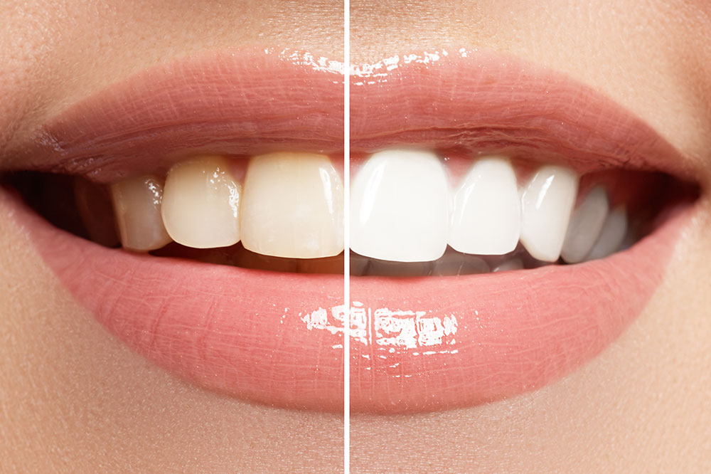 7 Effective At-home Teeth Whitening Procedures